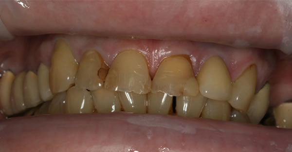 Restorative Dentistry Services Wisconsin