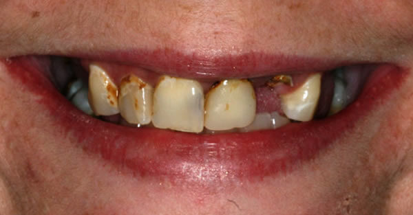 Restorative Dentistry Services Wisconsin